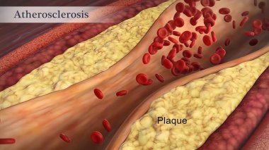 Clogged Artery with platelets and cholesterol plaque, concept for health risk for obesity 3D Render clipart
