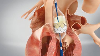 Yükselen aort anevrizmasında koroner rezisyon 3D