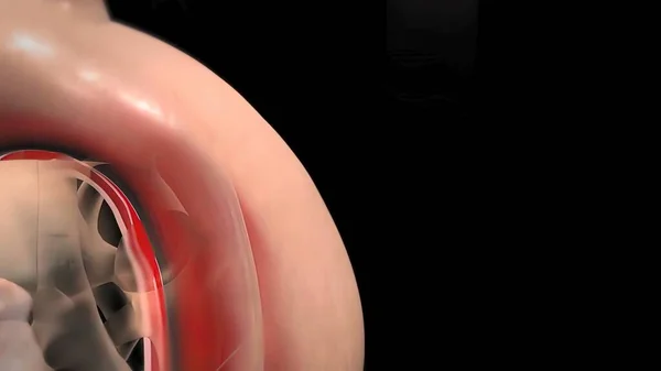 大動脈瘤と大動脈解剖 3Dレンダリング — ストック写真