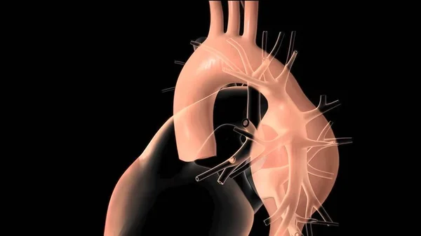 Síndrome Hipoplásico Del Corazón Izquierdo Defecto Cardíaco Congénito Poco Frecuente —  Fotos de Stock