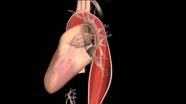 Hypoplastiskt Vänsterhjärtsyndrom Sällsynt Medfödd Hjärtdefekt Där Hjärtats Vänstra Sida Kraftigt — Stockfoto