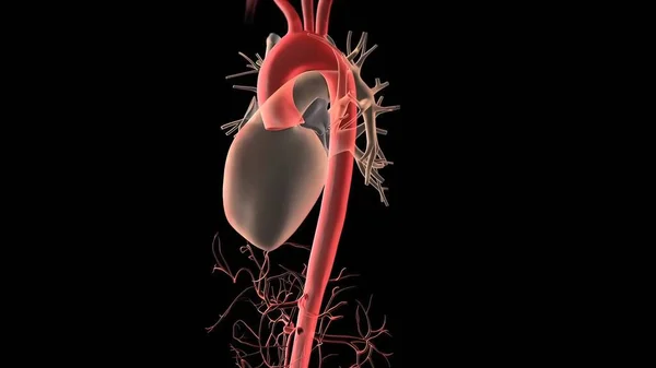 Aort anevrizması ve aort diseksiyonu 3D