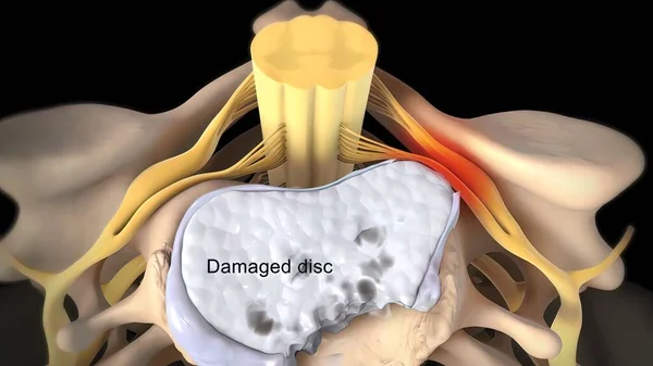 Spinal disc herniation is an injury to the cushioning and connective tissue between vertebrae, usually caused by excessive strain or trauma to the spine.