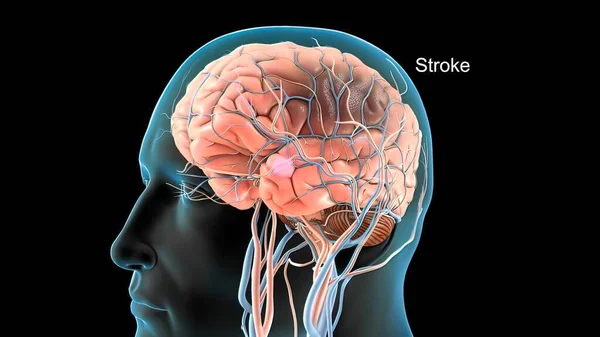 Cérebro Acidente Vascular Cerebral Renderização Médica — Fotografia de Stock