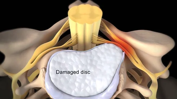 Spinal Disc Herniation Skade Dæmpning Bindevæv Mellem Ryghvirvler Normalt Forårsaget - Stock-foto