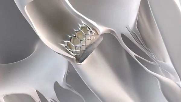 Expansión Del Implante Transcatéter Válvula Aórtica Medical Render —  Fotos de Stock