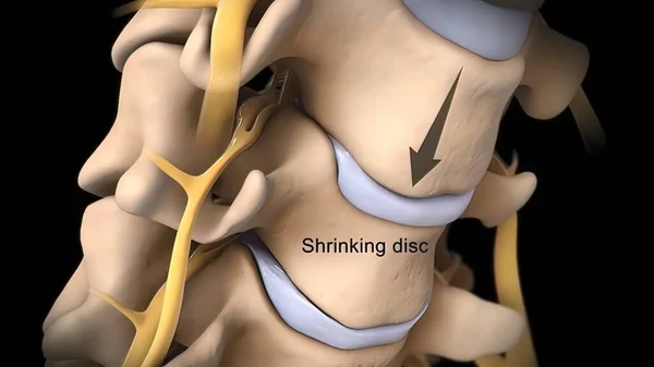 Spinal disc herniation is an injury to the cushioning and connective tissue between vertebrae, usually caused by excessive strain or trauma to the spine. 3D Render