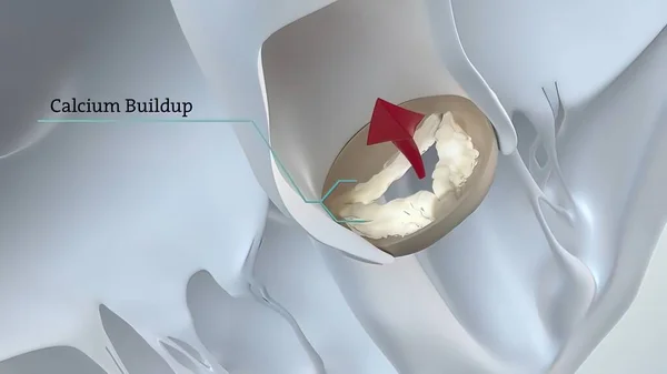 The aortic valve is a valve in the human heart between the left ventricle and the aorta. It is one of the two semilunar valves of the heart, the other being the pulmonary valve. 3D Render