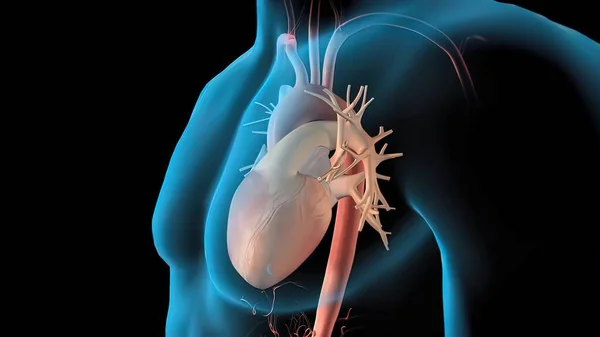 Aort anevrizması ve aort diseksiyonu 3D