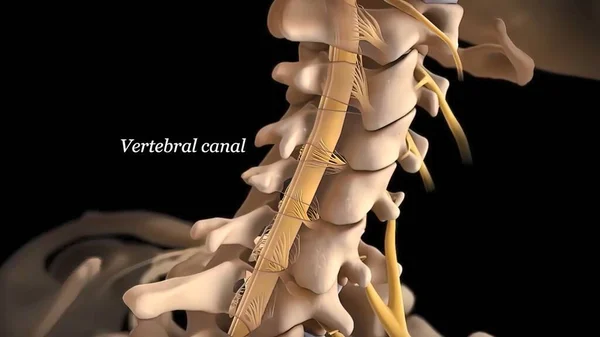 Spinal disc herniation is an injury to the cushioning and connective tissue between vertebrae, usually caused by excessive strain or trauma to the spine. 3D Render