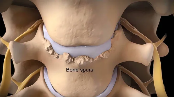 Spinal disc herniation is an injury to the cushioning and connective tissue between vertebrae, usually caused by excessive strain or trauma to the spine. 3D Render