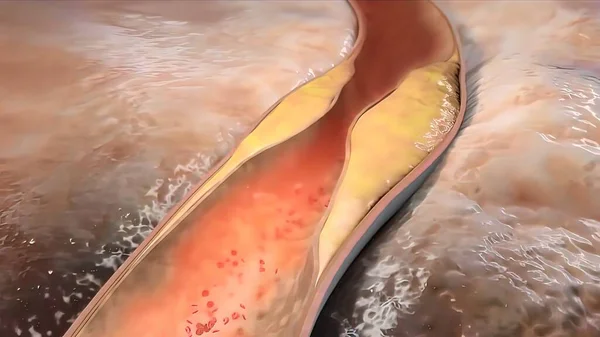 Verstopte Slagader Met Bloedplaatjes Cholesterol Plaque Concept Voor Gezondheidsrisico Voor — Stockfoto