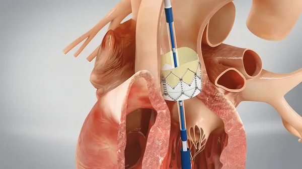上昇大動脈瘤で冠動脈再移植3Dレンダリング — ストック写真