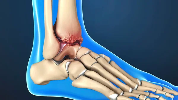 3D Render of Ankle Joint Anatomy and Osteoarthritis.The ankle is where the long tibia and fibula bones of the shin meet with the foot s talus bone.