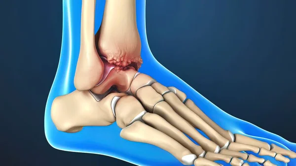 Render Kotníku Společné Anatomie Osteoartritidy Kotník Místo Kde Dlouhé Holenní — Stock fotografie