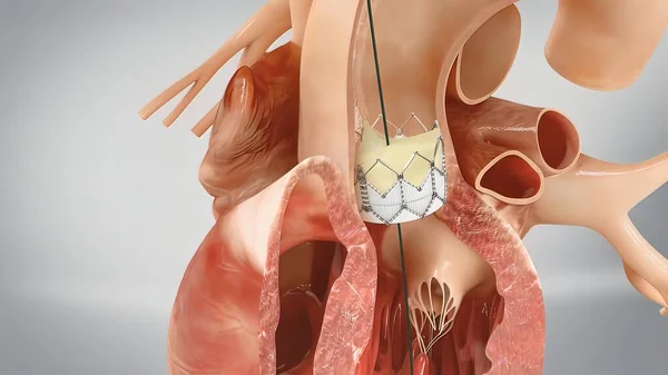 上昇大動脈瘤で冠動脈再移植3Dレンダリング — ストック写真