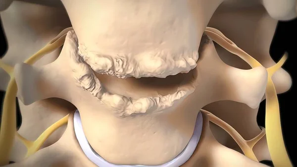 Spinal disc herniation is an injury to the cushioning and connective tissue between vertebrae, usually caused by excessive strain or trauma to the spine. 3D Render
