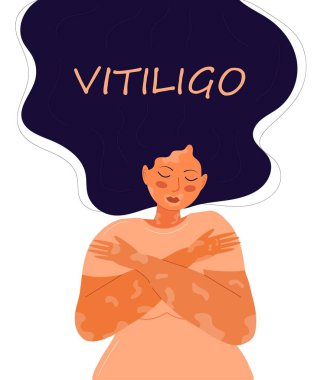 Vitiligo konsept vektörü. Dünya Vitiligo Günü illüstrasyonu. Deri hastalığı ve dermatolojik problemler. Sedef hastalığı, deri iltihabı, kızarıklık görüldü..