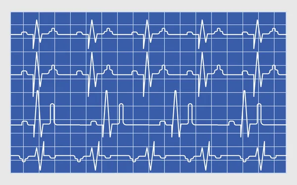 Elektrokardiyogram Sonuç Vektör Kavramı Acil Durum Için Ekg Monitörü Kalp — Stok Vektör