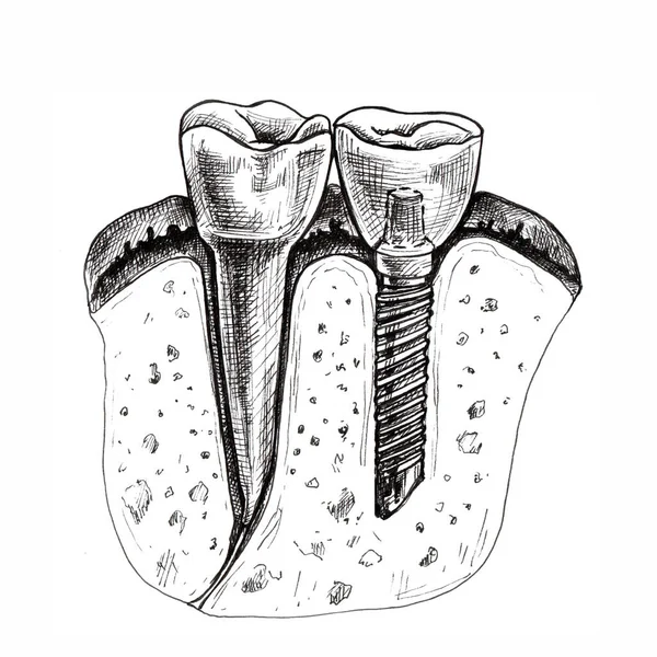 Healthy Tooth Implanted Hand Drawing Graphics Restoration Dentistry — Stock Fotó