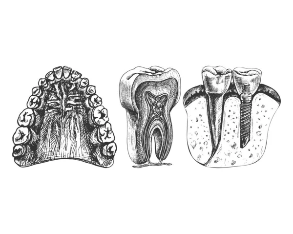 114_ jaw, teeth, gums, palate_dental implant_tooth structure, graphics jaw, teeth, gums, sky, graphics, isolated vector drawing, anatomical, detailed sketch, set, tooth, dental implant, colored,