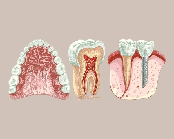 113 Mandíbula Dentes Gengivas Estrutura Palato Implante Dentário Dente Mandíbula —  Vetores de Stock