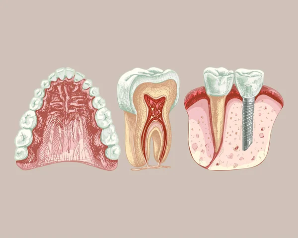 113_ jaw, teeth, gums, palate_dental implant_tooth structure, graphics jaw, teeth, gums, sky, graphics, isolated vector drawing, anatomical, detailed sketch, set, colored, tooth, dental implant, colored,