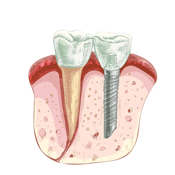 106_dental implant dentistry. part of gum, healthy tooth and dental implant, dental poster