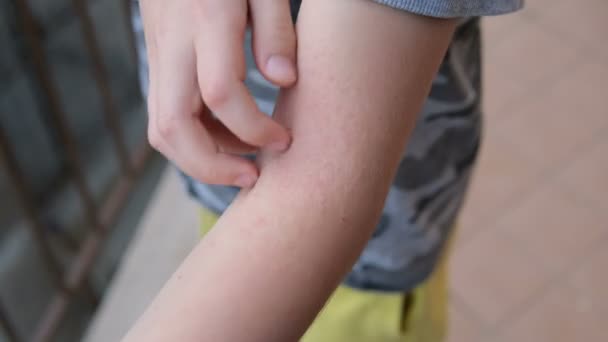 Niño Rasca Brazo Con Dermatitis Atópica Cuidado Salud Alergia Cutánea — Vídeos de Stock
