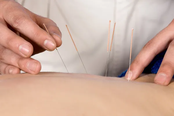 Sjukgymnast gör accupuncture — Stockfoto