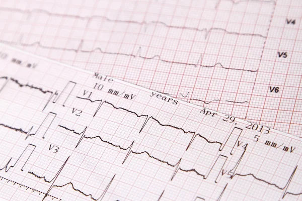 Eletrocardiograma para monitorar o coração — Fotografia de Stock