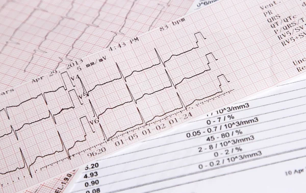 Eletrocardiograma controle da frequência cardíaca — Fotografia de Stock