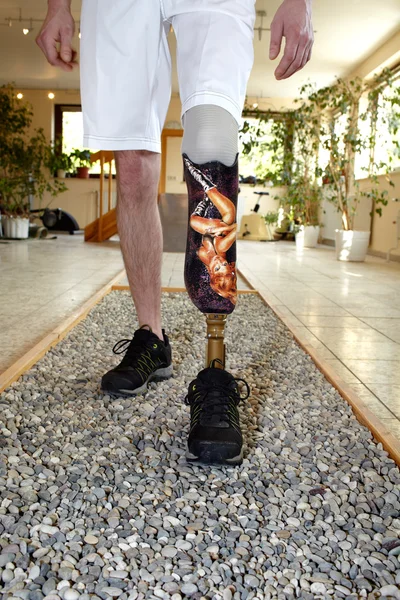 Usuário de prótese masculina aprendendo a andar — Fotografia de Stock