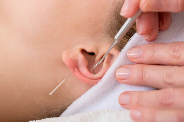 Omeopata trattamento donna con agopuntura . — Foto Stock