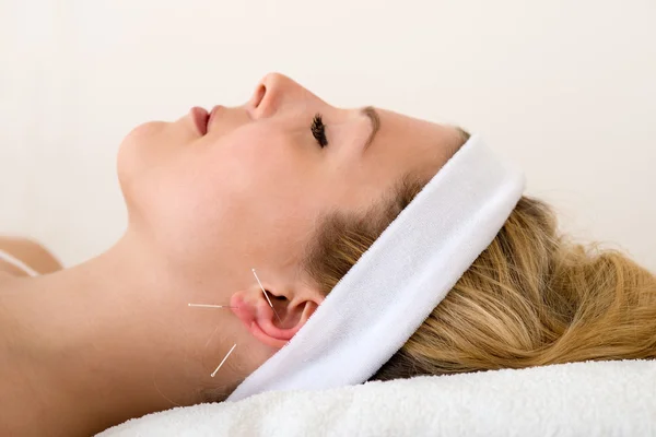 Beautiful woman having acupuncture. — Stock Photo, Image