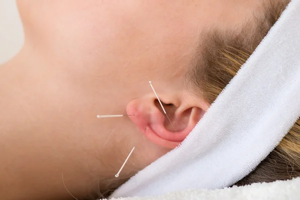 El primer plano de las agujas de acupuntura en una oreja . Imagen De Stock
