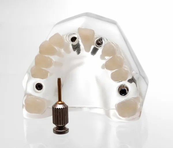 Zubní implants3 — Stock fotografie