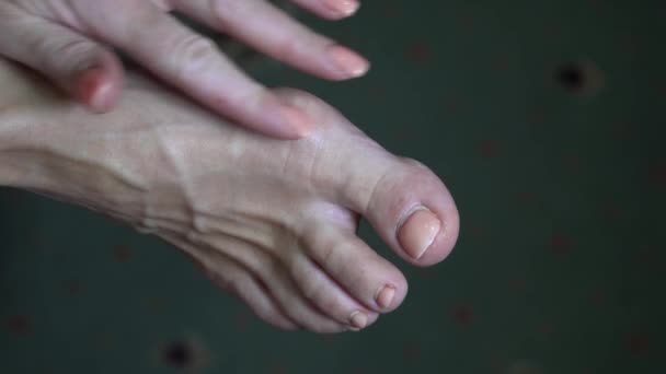 Неправильное Строение Ног Женщине Рост Боковой Кости Рядом Большим Пальцем — стоковое видео