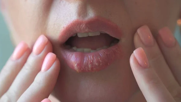 Kadınların dudaklarında uçuk hastalığı. Yakın plan..