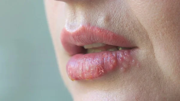 Doença Herpes Nos Lábios Das Mulheres Close — Fotografia de Stock