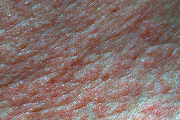 Kožní Textura Bolestivá Červených Blistrech Kožní Vyrážky Chemickém Popálení — Stock fotografie