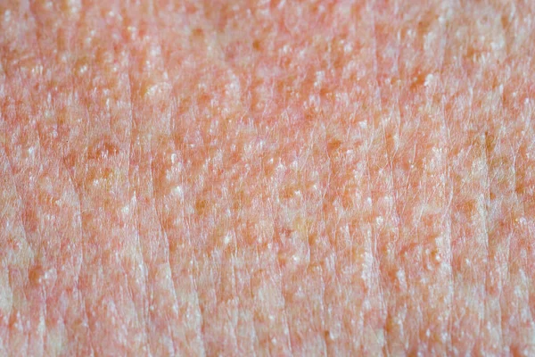 Skin Texture Painful Red Blisters Skin Rashes Chemical Burn — Stock Photo, Image