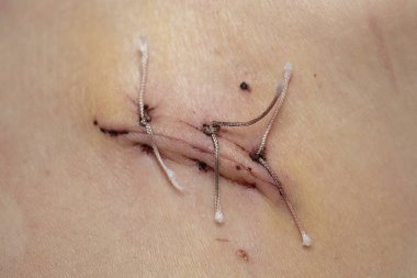 Apandisitten sonra düzenli dikiş, yakın çekim, dikiş ve medikal ipliklerin makro fotoğrafı.