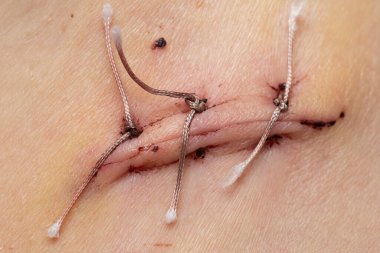Apandisitten sonra düzenli dikiş, yakın çekim, dikiş ve medikal ipliklerin makro fotoğrafı.