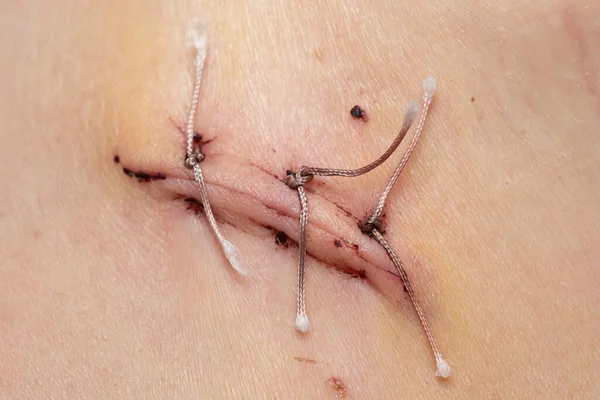 虫垂炎 クローズアップ 縫合糸と医療糸のマクロ写真の後のきちんとした縫合 ロイヤリティフリーのストック画像