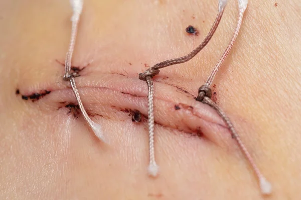 虫垂炎 クローズアップ 縫合糸と医療糸のマクロ写真の後のきちんとした縫合 ストック写真