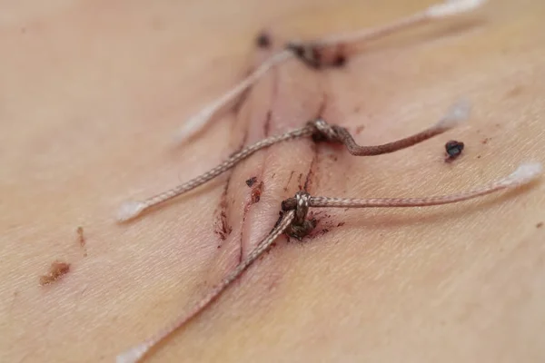 虫垂炎 クローズアップ 縫合糸と医療糸のマクロ写真の後のきちんとした縫合 ロイヤリティフリーのストック写真