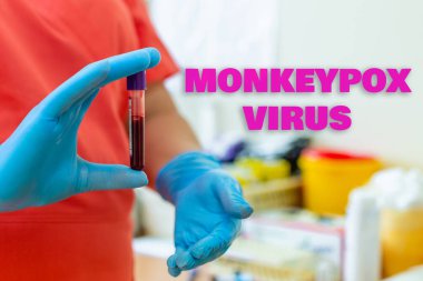 Maymun çiçeği salgını. Yazı maymunu virüsü. İnsanlara hayvanlardan bulaşan virüs. Kan testi yapan laboratuvar hemşiresi..