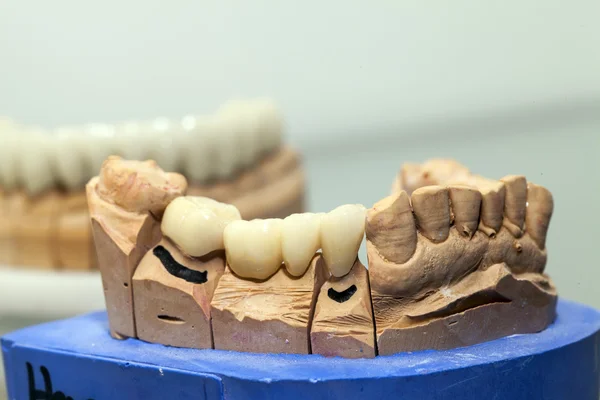 Zirconium Porcelain Tooth plate in Dentist Store — Stock Photo, Image