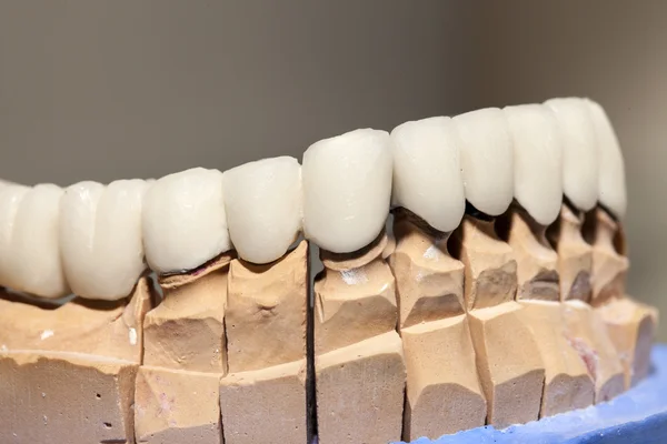 Цирконій порцеляни зуба пластини в магазині стоматолог — стокове фото